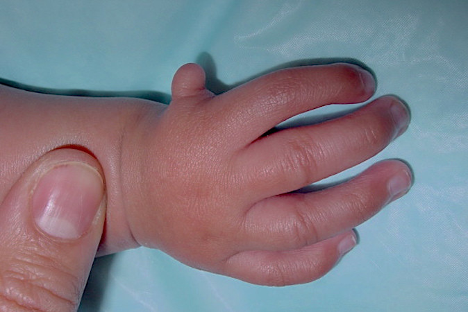 Hypoplastic thumb