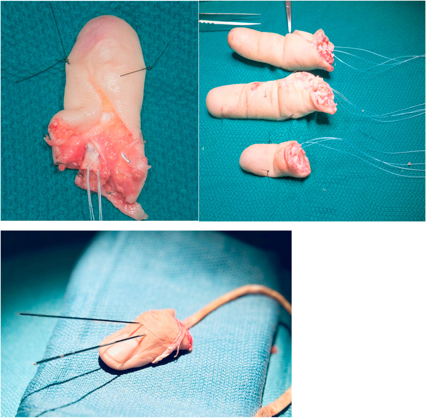 Traumatic injuries, microsurgery and replantation