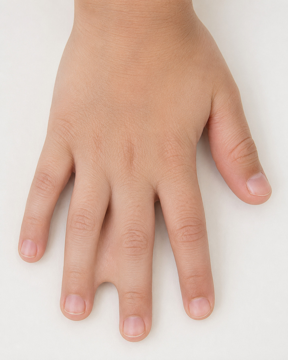 Before — Syndactyly
