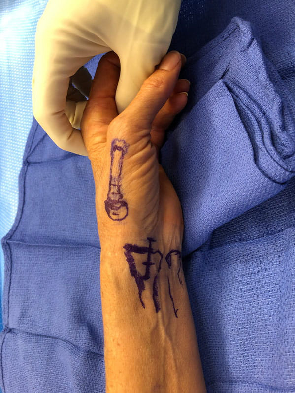Arthritis
