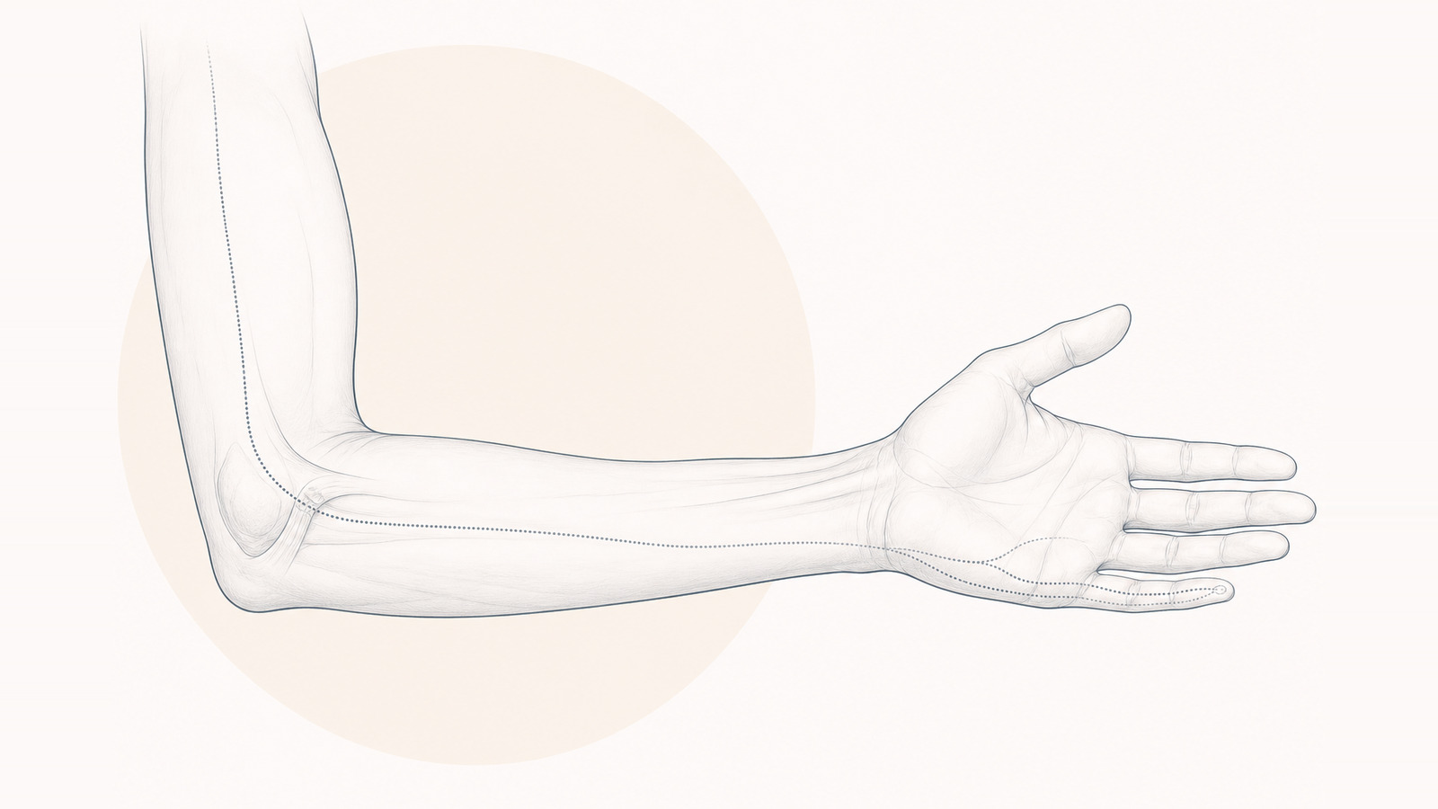 Cubital tunnel syndrome