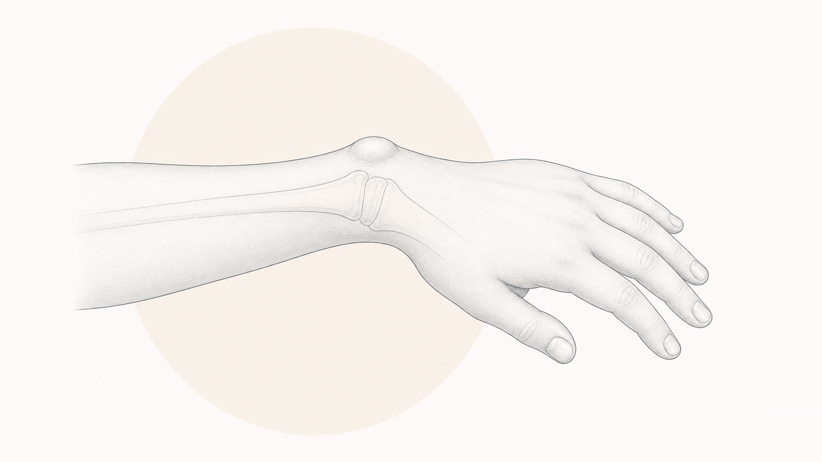 Madelung deformity