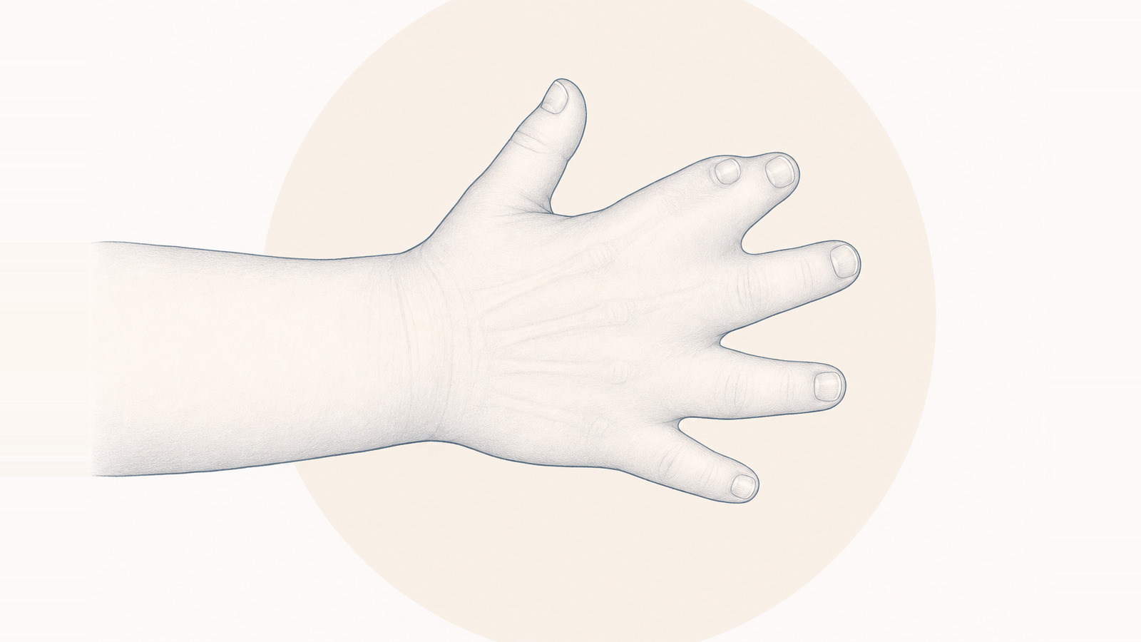 Syndactyly